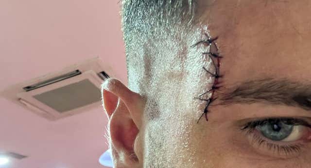 Así quedó el rostro de Embarba tras el choque con Diakhaby
