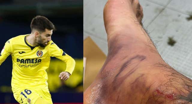 “No podía ni andar”: una infiltración y la foto que demuestra cómo quedó el tobillo de Álex Baena tras el Bernabéu