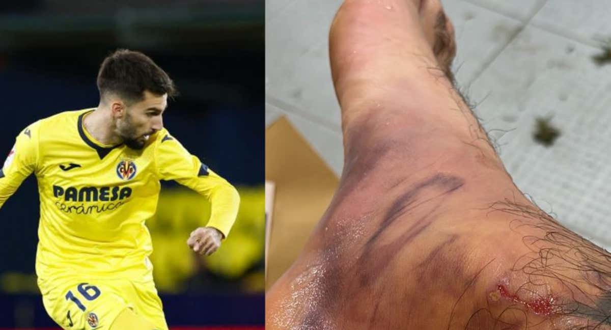 Baena y como quedó su tobillo tras el Bernabéu.
