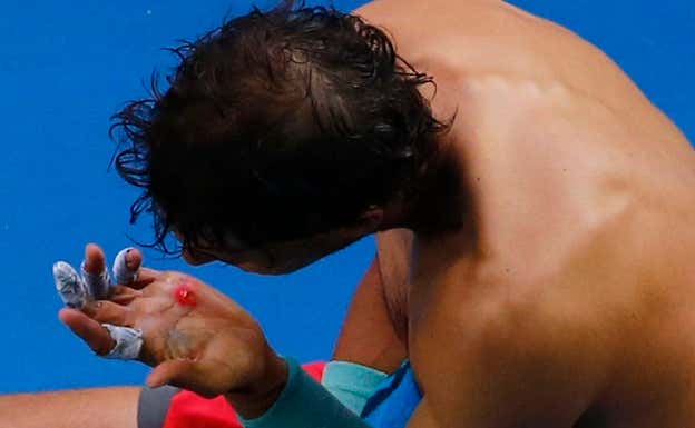 La ampolla de Rafael Nadal en el Open de Australia 2014. Archivo