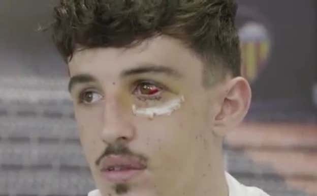 Así ha quedado el ojo de Diego López tras su derrame ocular.  Valencia C.F