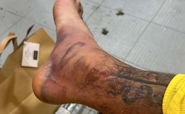 Así quedó el pie de Álex Baena tras la patada de Lucas Vázquez.  Relevo.