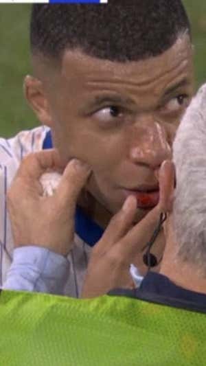 Así quedó la nariz de Mbappé.