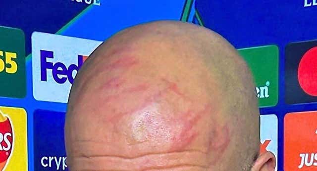 Guardiola revela entre risas qué hay detrás de su imagen viral con la cabeza llena de arañazos: “Quiero herirme a mí mismo”